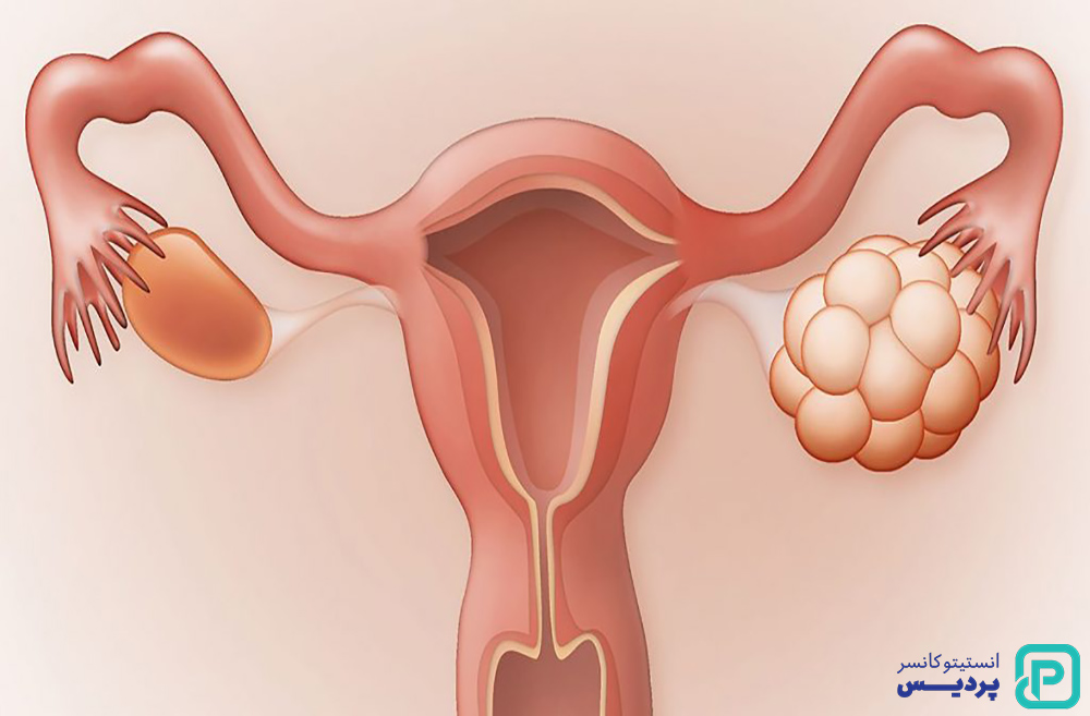 روش های درمانی سرطان تخمدان را بشناسید 3 درمان سرطان تخمدان