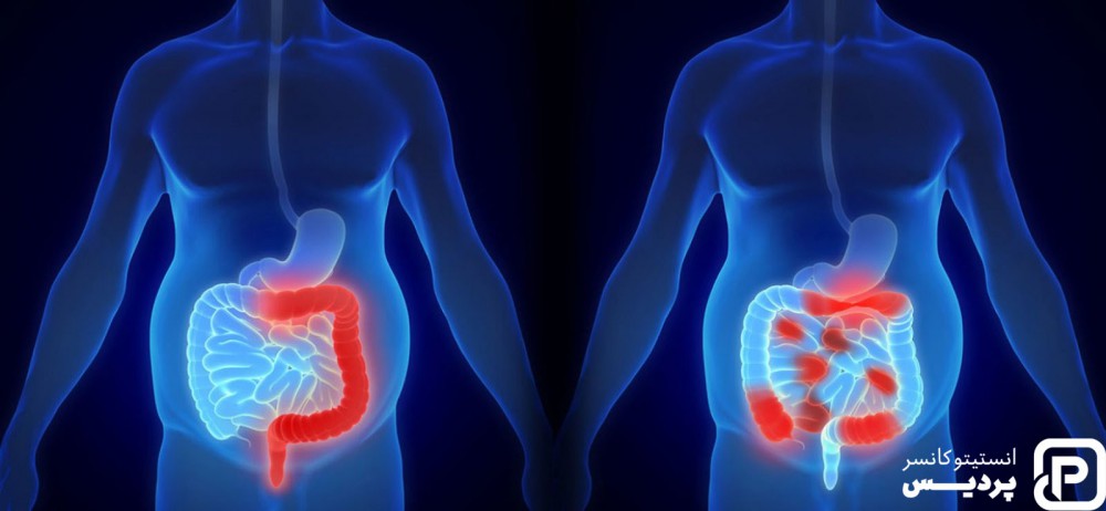 پیشرفت سرطان روده چگونه اندازه گیری می شود؟