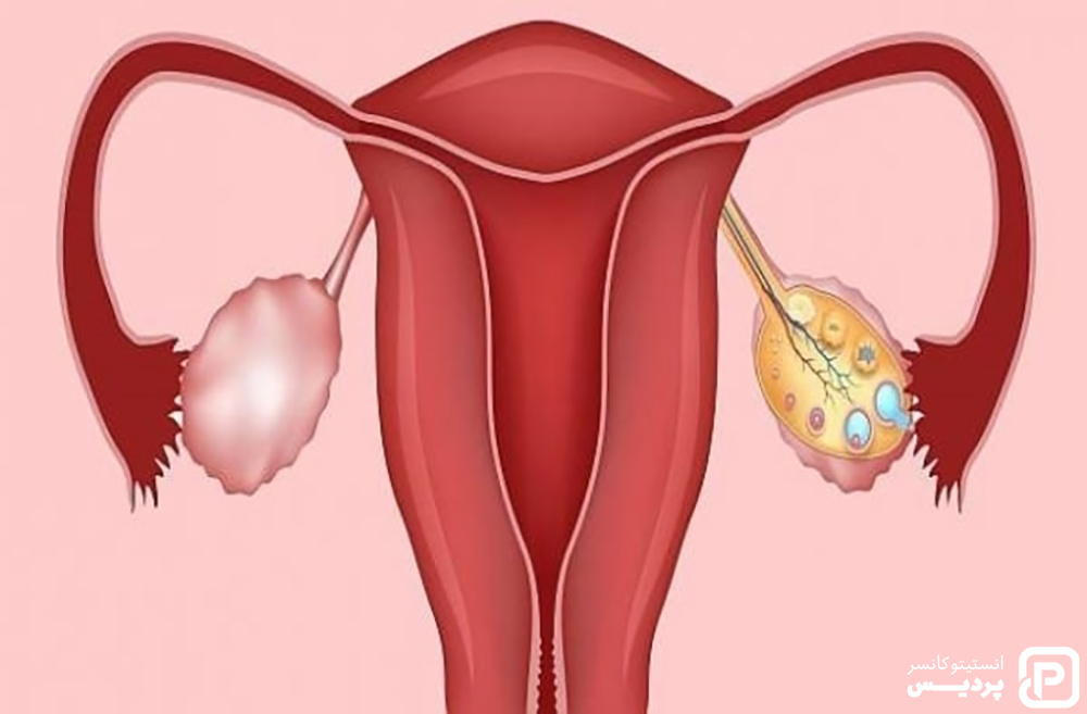 روش های درمانی سرطان تخمدان را بشناسید 7 سرطان تخمدان و درمان های موثر آن