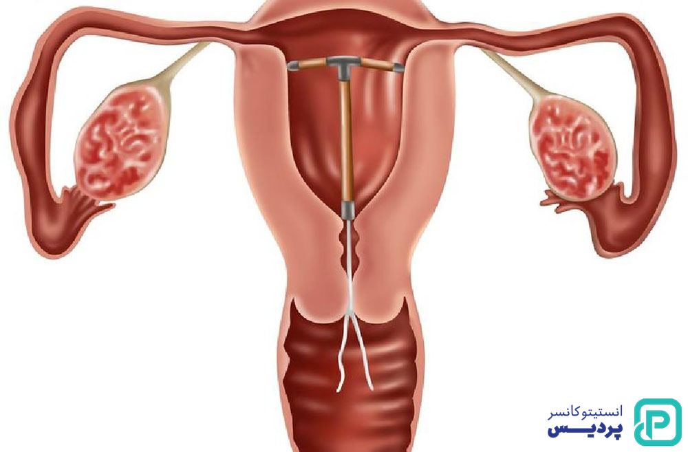 جراحی برای درمان سرطان دهانه رحم