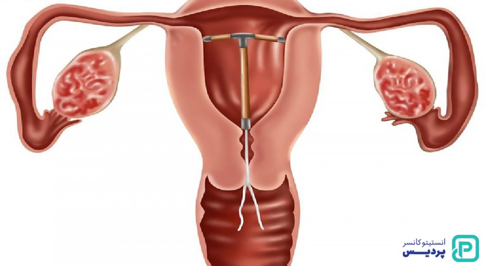 جراحی برای درمان سرطان دهانه رحم