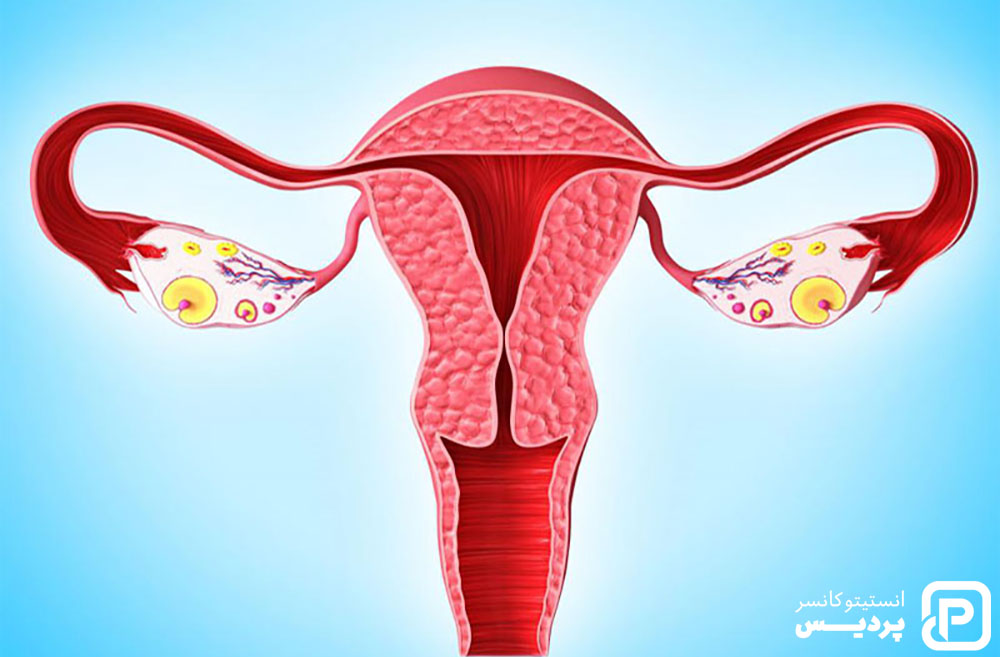 روش های درمانی سرطان دهانه رحم