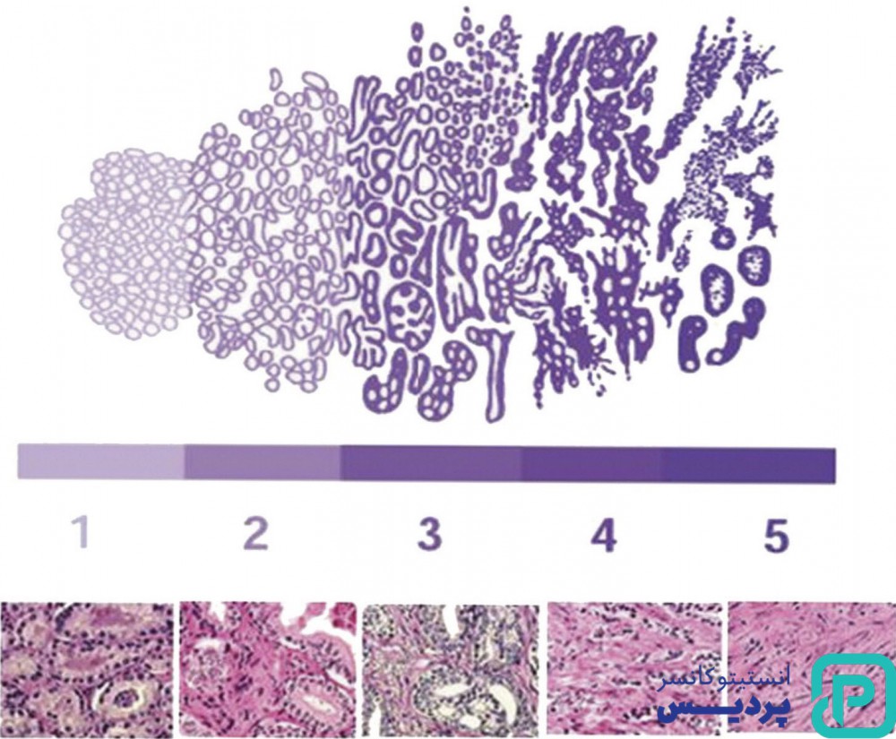 تشخیص به موقع سرطان پروستات