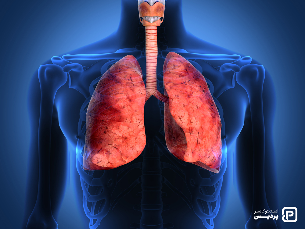 سرطان ریه چیست 2 سرطان ریه چیست؟