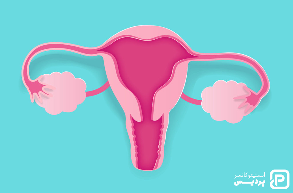 سرطان تخمدان را بیشتر بشناسید 4 همه چیز درباره سرطان تخمدان