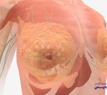 علائم سرطان سینه و راه های شناخت علائم سرطان پستان - 22