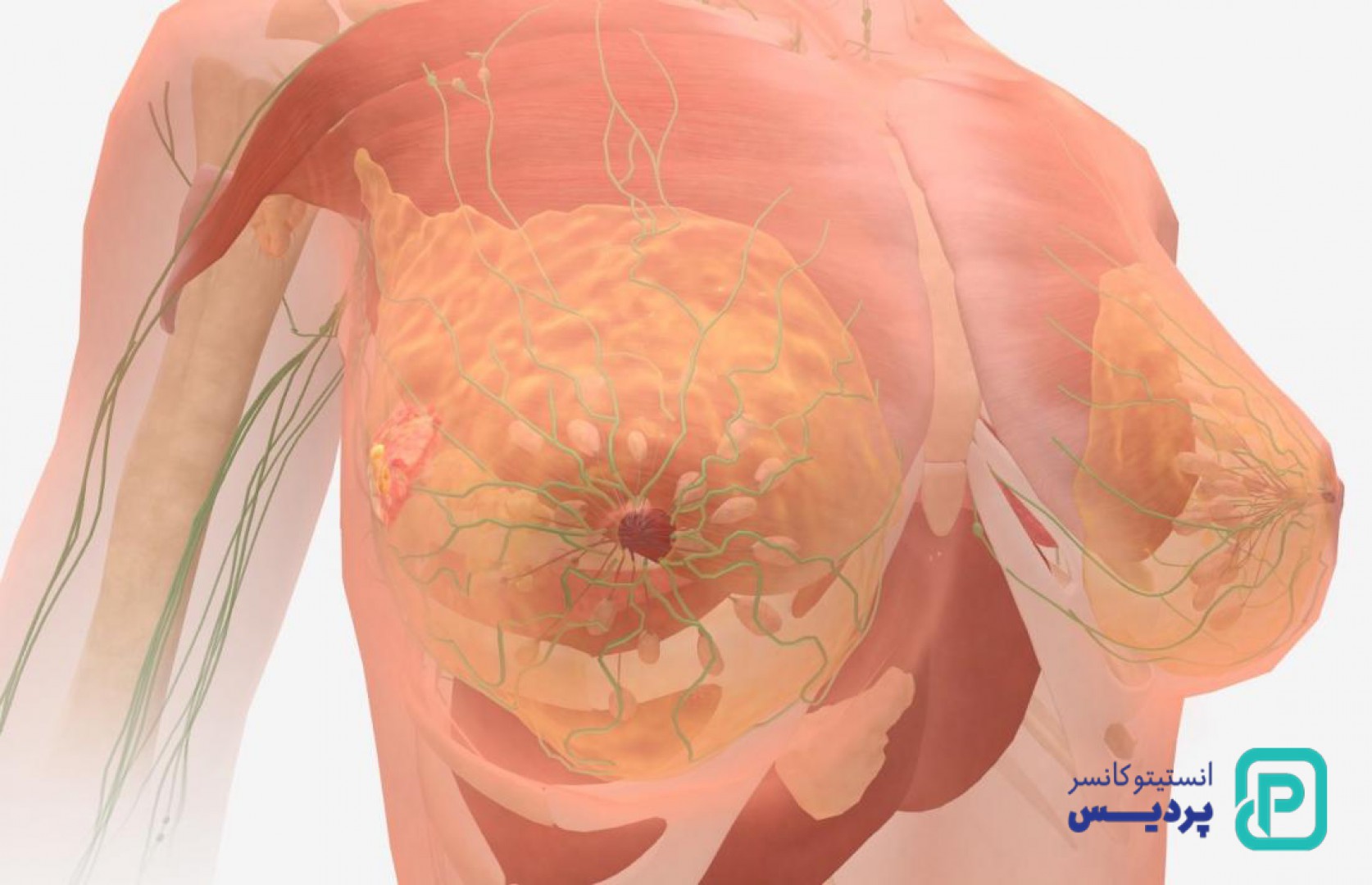 علائم سرطان سینه و راه های شناخت علائم سرطان پستان - 1