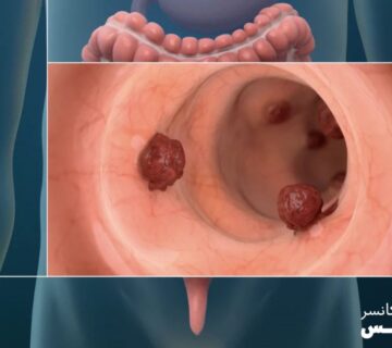 چگونه از بروز سرطان روده بزرگ جلوگیری کنیم؟ - 6