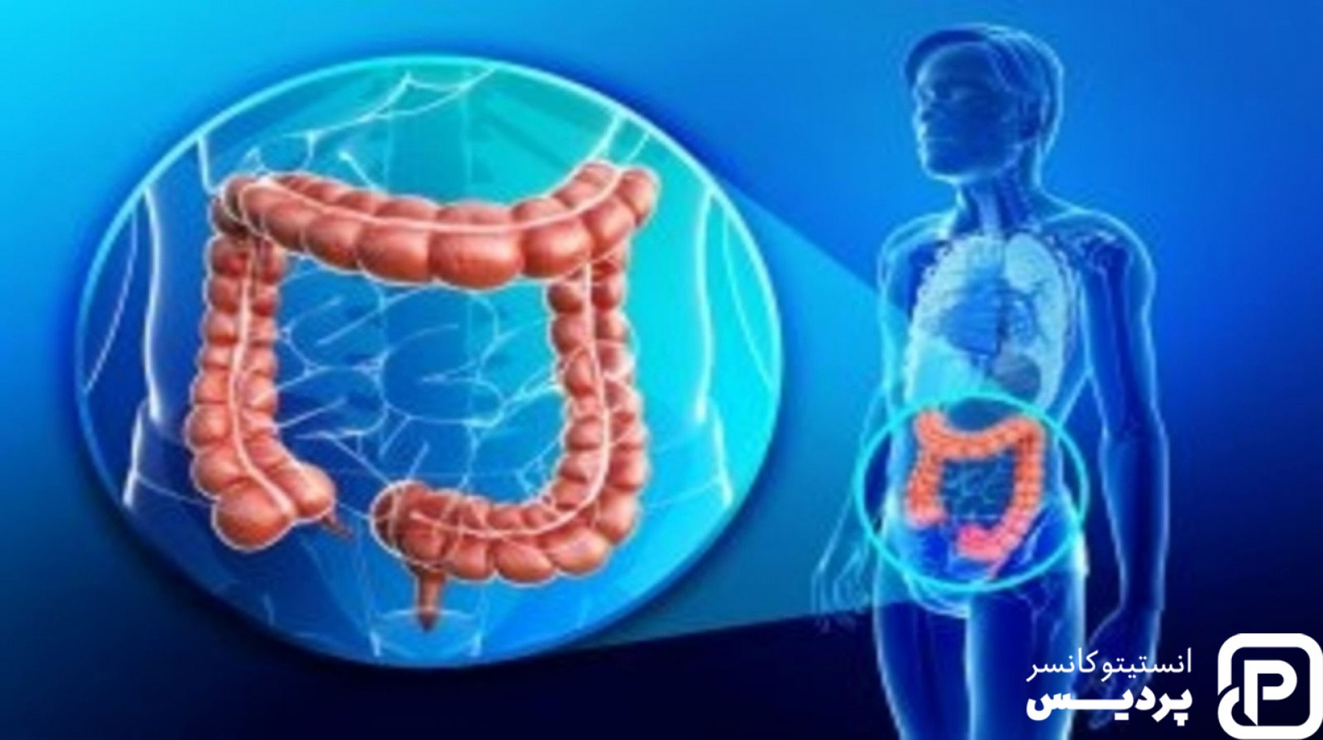 سرطان روده بزرگ چگونه تشخیص داده می شود؟ - 1