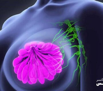 درجه بندی سرطان سینه چگونه است و چه معیارهایی دارد؟ - 23