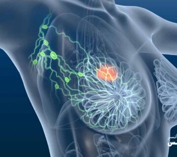 سرطان متاستاتیک سینه، علائم و نشانه ها و راههای درمان آن - 5
