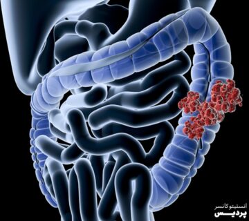 پیشرفت سرطان روده بزرگ چگونه اندازه گیری می شود؟ - 5