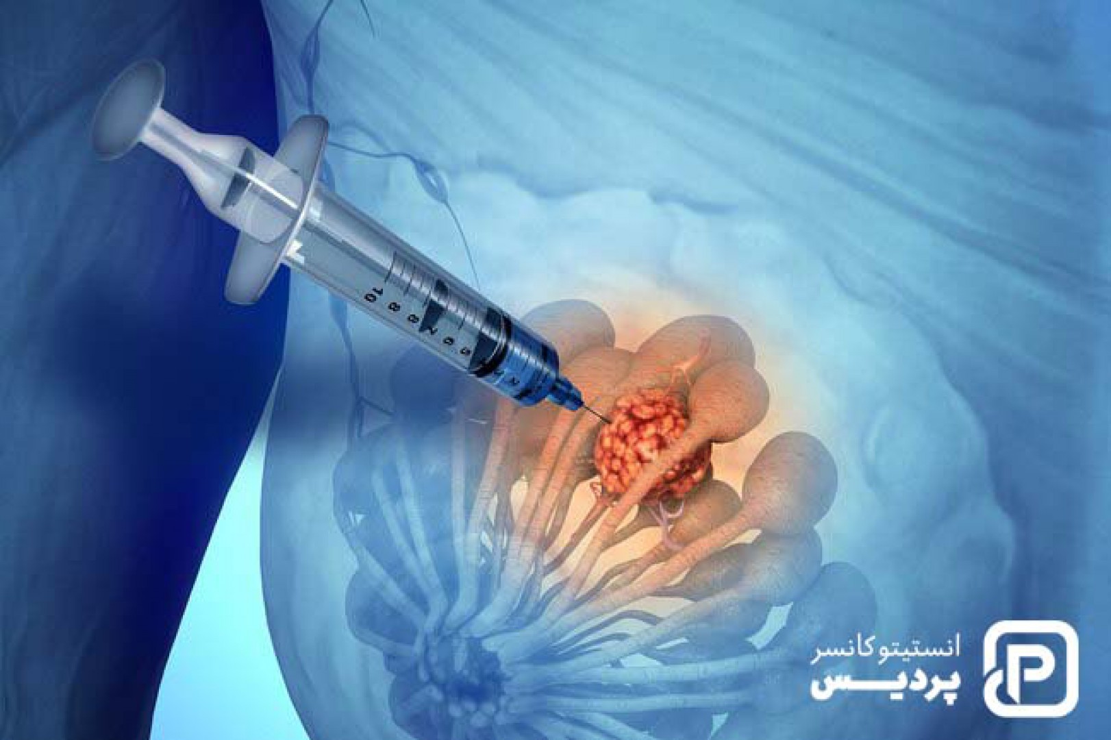 چگونه بیوپسی پستان به تشخیص سرطان سینه کمک می کند؟ 1 Image 655e45f71d7ad