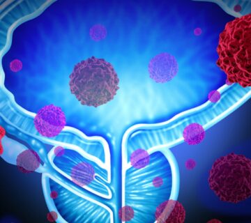 مرحله بندی سرطان پروستات چگونه است و چه معیارهایی دارد؟ - 4