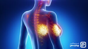 انواع نادر سرطان سینه را بشناسید - 8