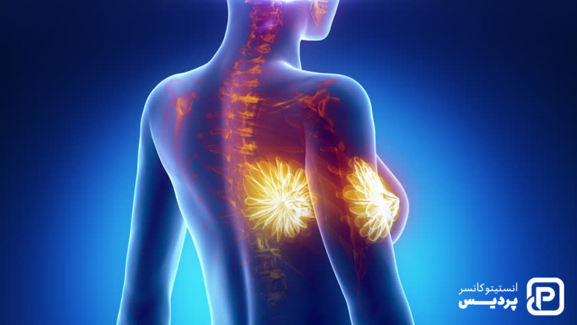 انواع نادر سرطان سینه را بشناسید - 1