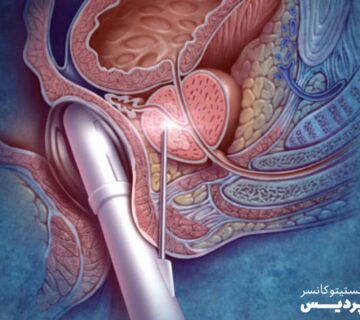 بیوپسی پروستات چیست و به چه منظور انجام می شود؟ - 28
