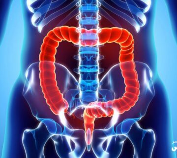 علائم سرطان روده بزرگ را بشناسید و جدی بگیرید 1 علائم سرطان روده بزرگ را بشناسید و جدی بگیرید - 1