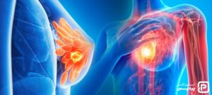 سرطان سینه عود کننده چیست و چه علائمی دارد - 9