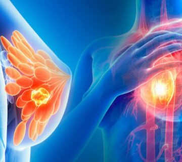 سرطان سینه عود کننده چیست و چه علائمی دارد - 16