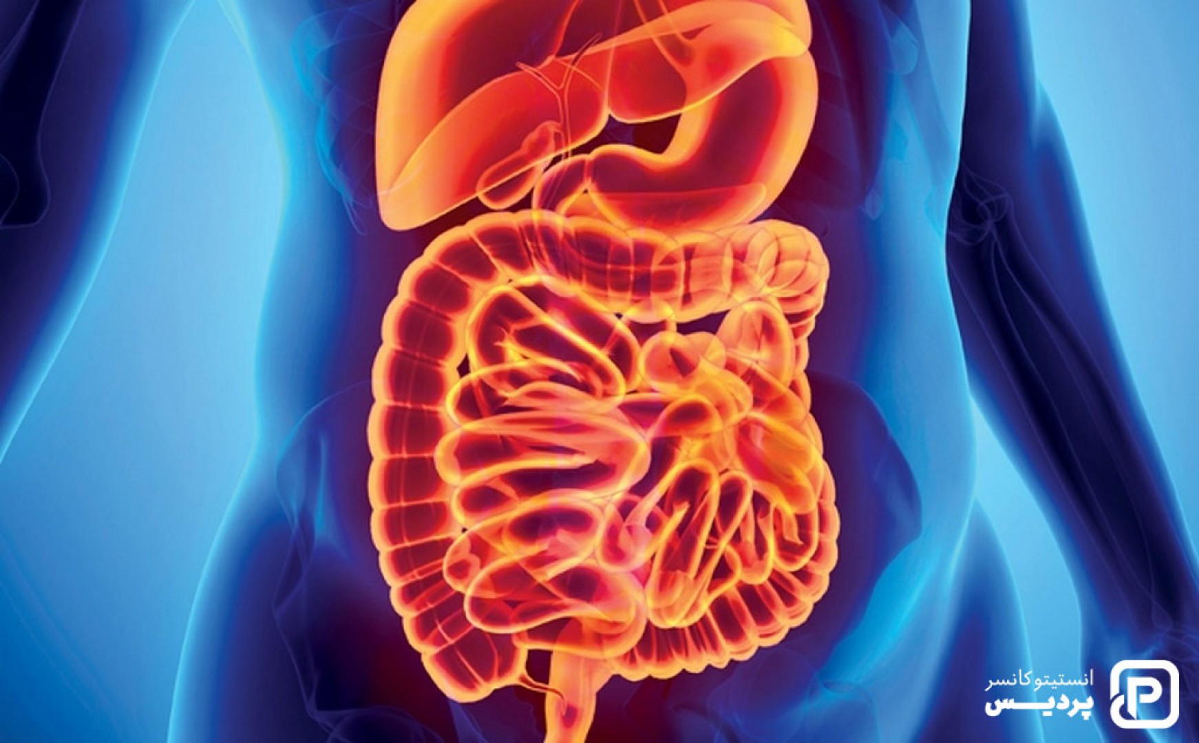 سرطان روده متاستاتیک، علائم و نشانه ها و راههای درمان آن - 1