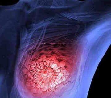 چه عواملی خطر ابتلا به سرطان سینه را افزایش می دهند - 14