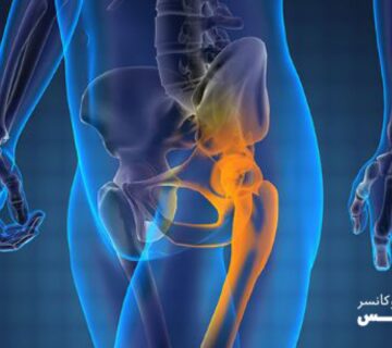 سرطان پروستات پیشرفته، علائم و نشانه ها و راههای تشخیص و درمان آن - 2