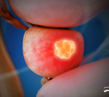 علت سرطان پروستات چیست - 1