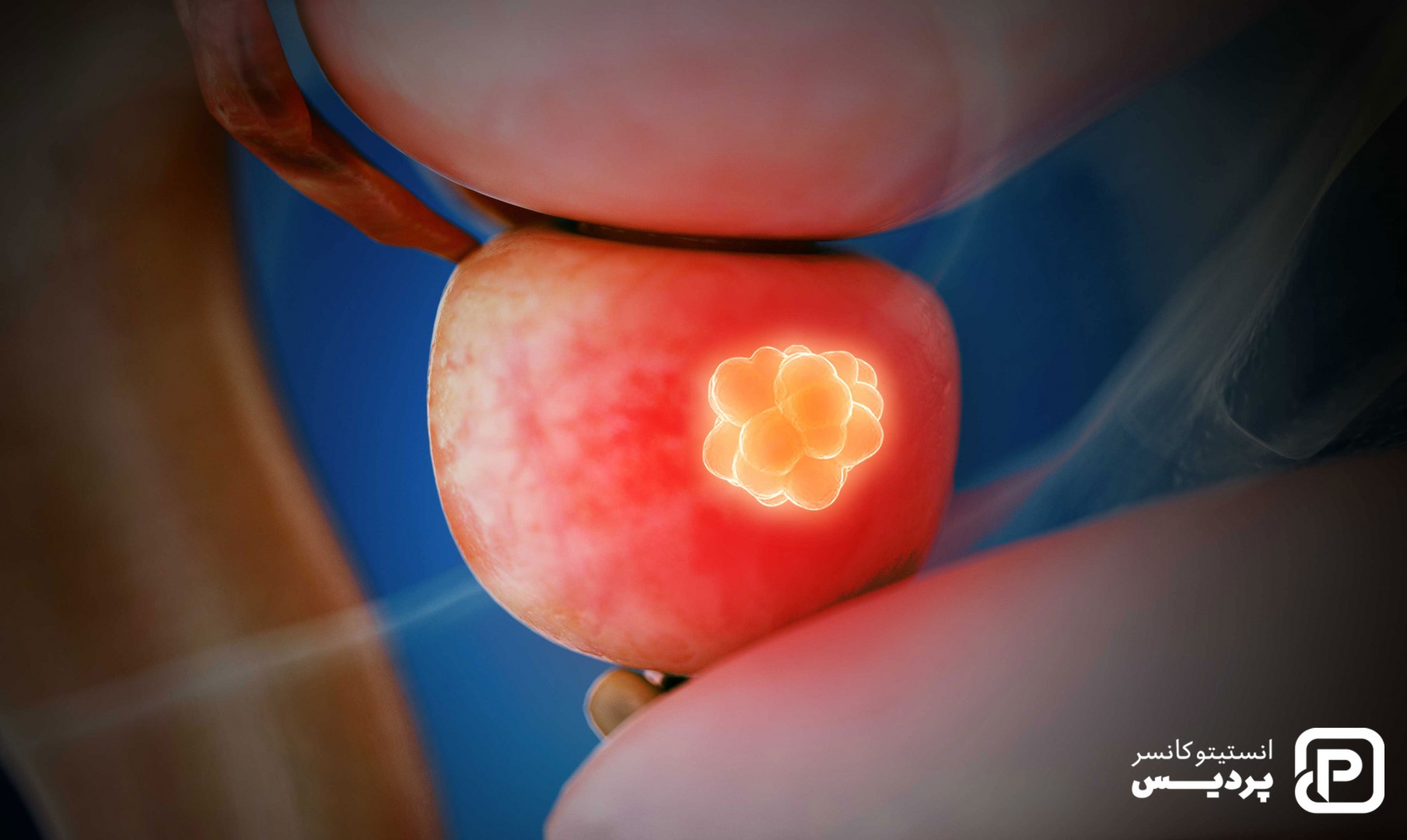 علت سرطان پروستات چیست - 1