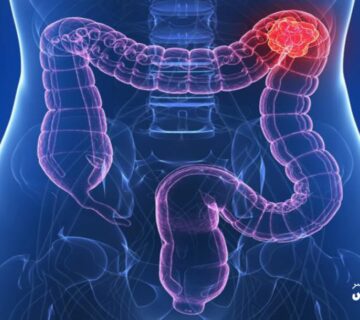 چه عواملی خطر ابتلا به سرطان روده بزرگ را افزایش می دهند 1 Image 655e4602eec96 360x320