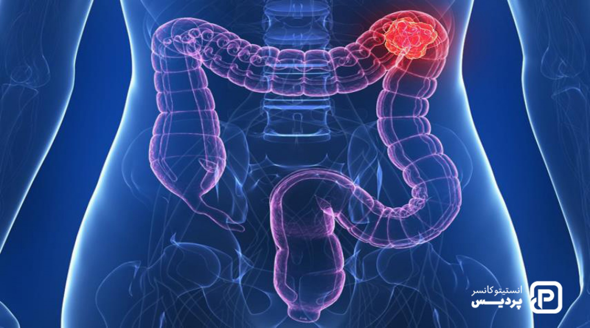 چه عواملی خطر ابتلا به سرطان روده بزرگ را افزایش می دهند - 1