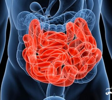 سرطان روده کوچک، علائم و نشانه ها و راههای تشخیص و درمان آن 41 Image 655e4603b4a43 360x320