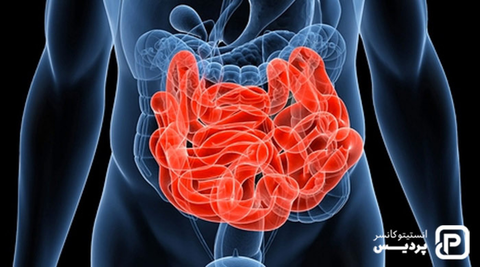 سرطان روده کوچک، علائم و نشانه ها و راههای تشخیص و درمان آن 1 سرطان روده کوچک، علائم و نشانه ها و راههای تشخیص و درمان آن - 1