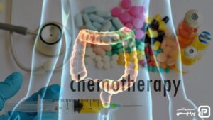 شیمی درمانی چگونه به درمان سرطان روده بزرگ کمک می کند؟ - 6