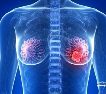 نقش هورمون درمانی در درمان سرطان سینه - 14
