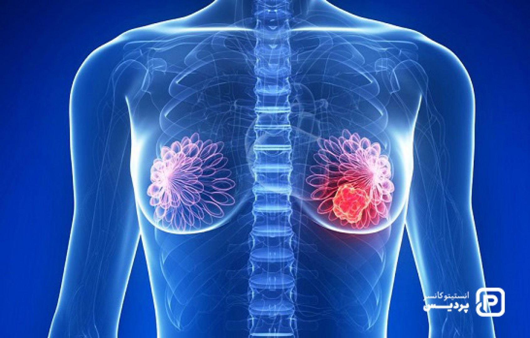 نقش هورمون درمانی در درمان سرطان سینه 1 نقش هورمون درمانی در درمان سرطان سینه - 1