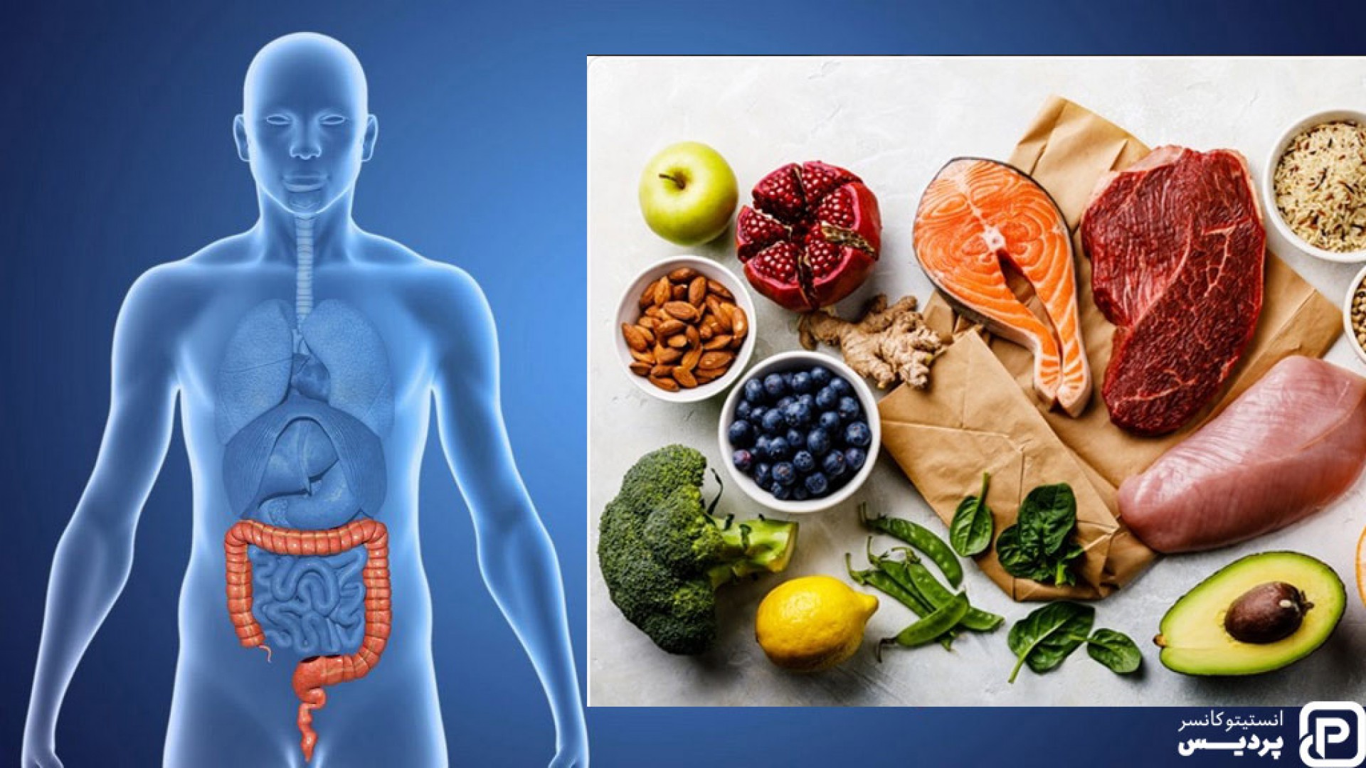 نقش تغذیه در پیشگیری از سرطان روده بزرگ - 1