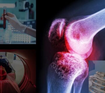 با روش های تشخیص سرطان استخوان و چگونگی انجام آنها آشنا شوید - 1