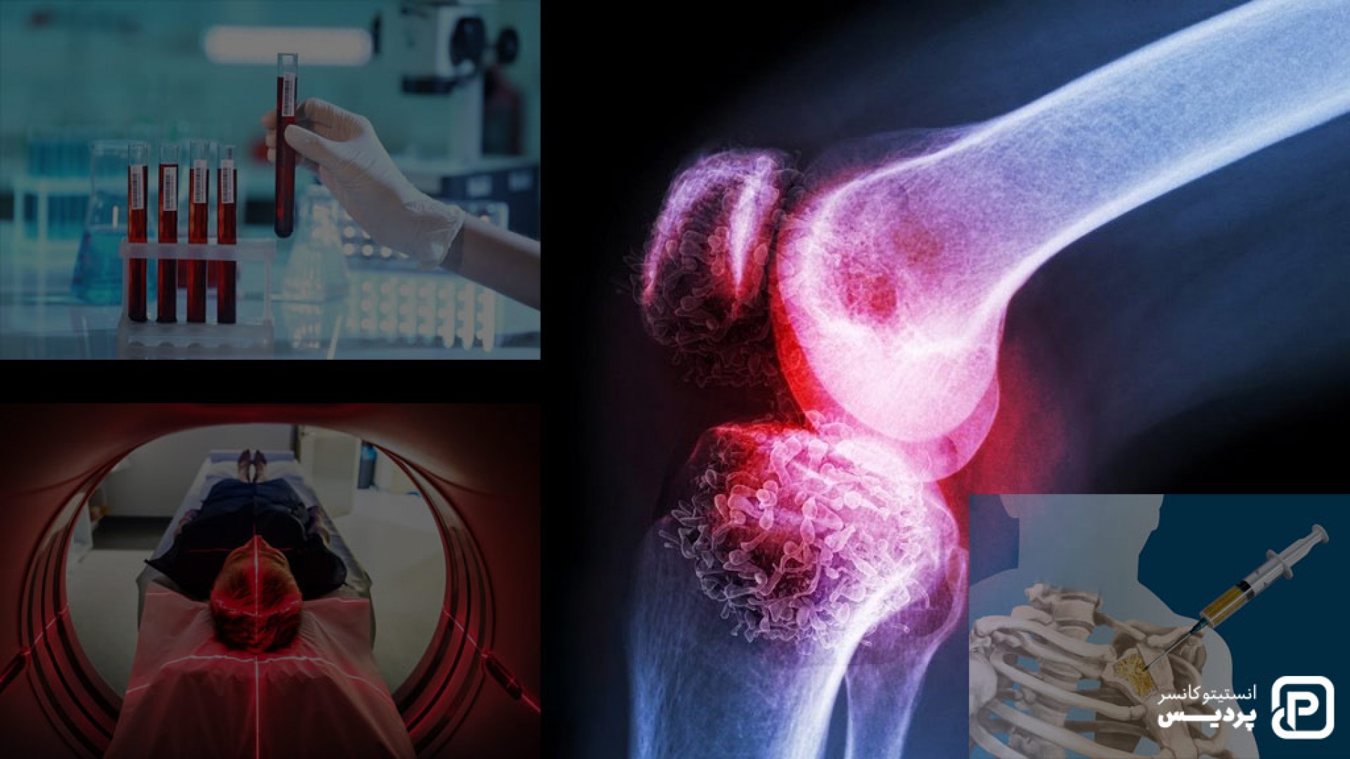 با روش های تشخیص سرطان استخوان و چگونگی انجام آنها آشنا شوید 1 با روش های تشخیص سرطان استخوان و چگونگی انجام آنها آشنا شوید - 1