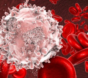 سرطان خون چیست و راههای تشخیص و درمان آن کدامند؟ - 36