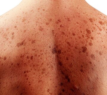 سرطان پوست سلول پایه و سنگفرشی - 13