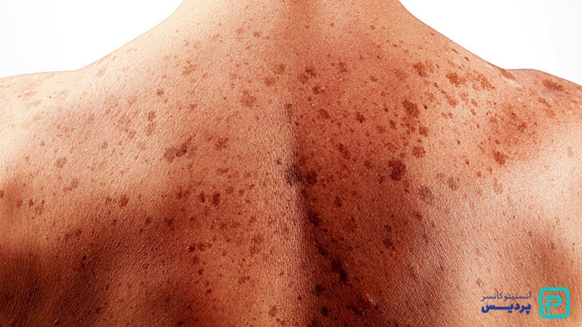 سرطان پوست سلول پایه و سنگفرشی 1 سرطان پوست سلول پایه و سنگفرشی - 1