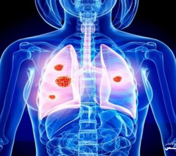 سرطان ریه چیست - 13