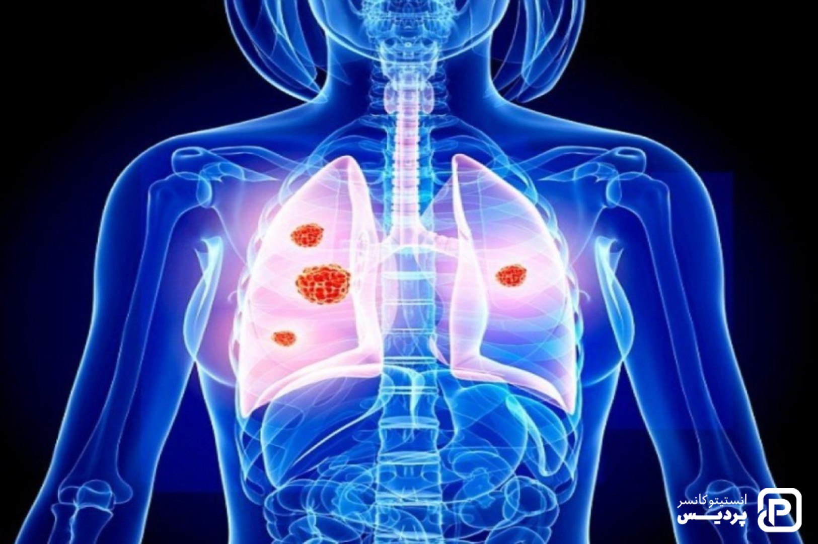 سرطان ریه چیست 1 سرطان ریه چیست - 1