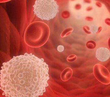 مرحله بندی سرطان خون چگونه انجام می شود و چه معیارهایی دارد - 11