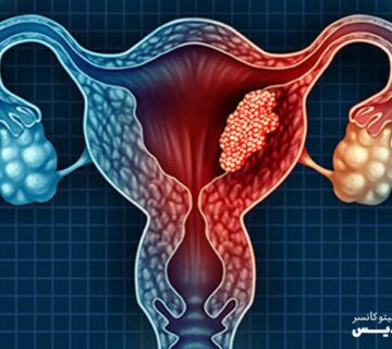 انواع روش های درمان سرطان دهانه رحم - 8
