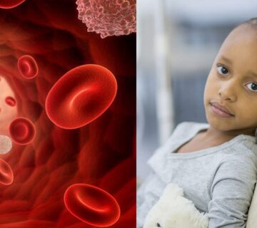 روش های درمان سرطان خون در کودکان را بشناسید 3 Image 655e4621a2391 360x320