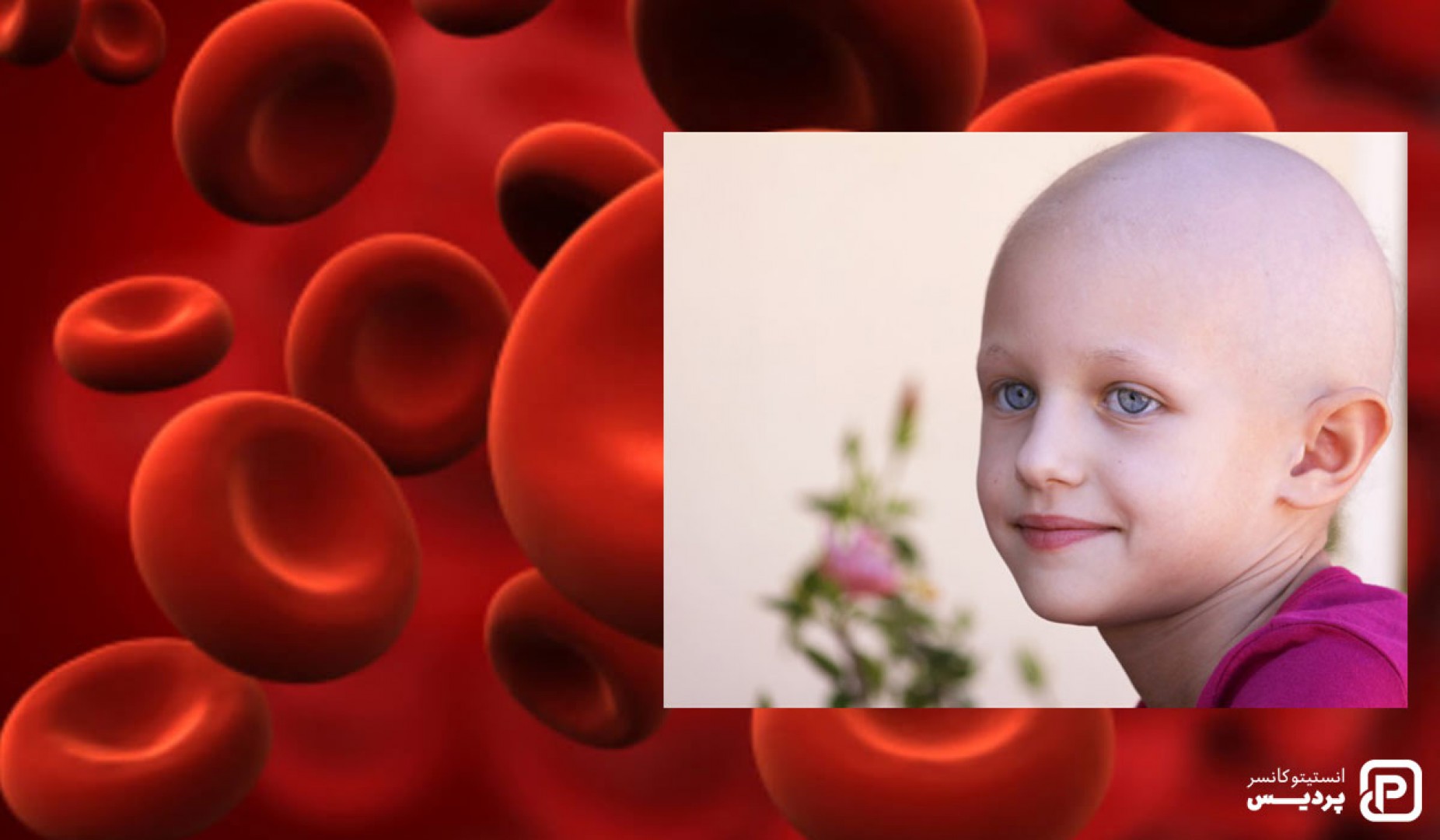 چگونه می توان از سرطان خون در کودکان پیشگیری کرد - 1