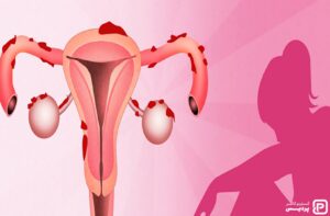 تشخیص سرطان دهانه رحم به چه صورت انجام می شود؟ - 17