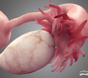 سرطان تخمدان را بیشتر بشناسید - 11